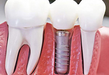 Имплантация зубов – верните себе улыбку