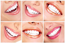 Отбеливание зубов - белосежная улыбка