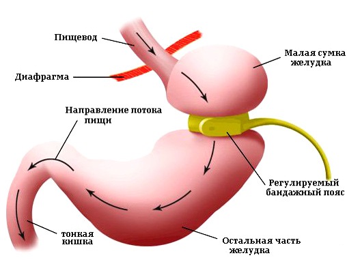 бариатрическая хирургия