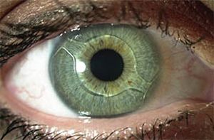 Так выглядит глаз с имплантированной линзой Cachet после коррекции близорукости.