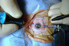 микрохирургия глаза, Приморский край