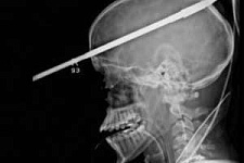 Американские хирурги успешно извлекли 90-сантиметровый гарпун из черепа подростка
