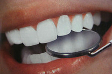 Новые зубы за один час