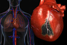 Ученые совершили прорыв в лечении инфаркта миокарда
