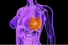 Генетический скрининг поможет в лечении рака груди