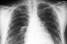 В России снижается заболеваемость туберкулезом