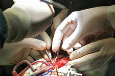 Российские кардиохирурги вживили первый отечественный полноприточный клапан