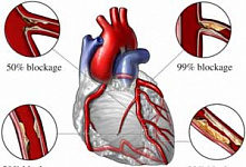 Приостановка кровообращения в руке помогает при инфаркте