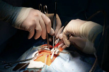 Австралийские хирурги впервые в мире пересадили "мертвое" сердце