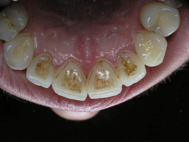 состояние зубов человека может многое сказать о здоровье всего организма