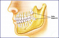 Удаление зуба мудрости: показания к процедуре и особенности процесса