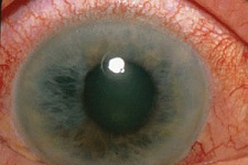 Больных глаукомой спасет от слепоты имплантируемый барометр