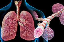 Плохая экология и вредные привычки могут спровоцировать появление бронхиальной астмы