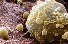 Раскрыт секрет устойчивости меланомы к химиотерапии