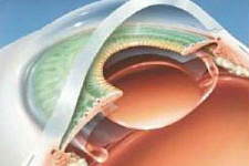 Новую модель искусственного хрусталика изобрели специалисты  Приморского центра микрохирургии глаза