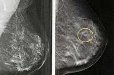 Скрининговая маммография до 40 лет бесполезна?