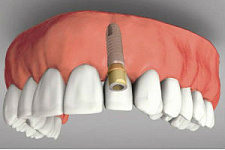 Здоровье полости рта оценит Bluetooth-имплантант 