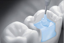 Британская компания разработала устройство для самолечения зубов от кариеса