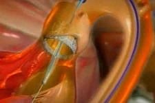Австралийские врачи успешно вживили 11 искусственных клапанов сердца без операции