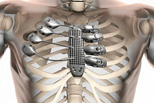 Революция в хирургии: больному раком имплантировали 3D-ребра (ВИДЕО)