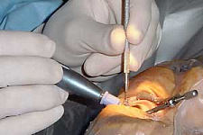 Хирургическое лечение катаракты спасает от перелома шейки бедра 