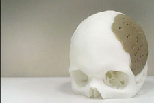 75% черепа американца заменили распечатанным на 3D-принтере имплантом